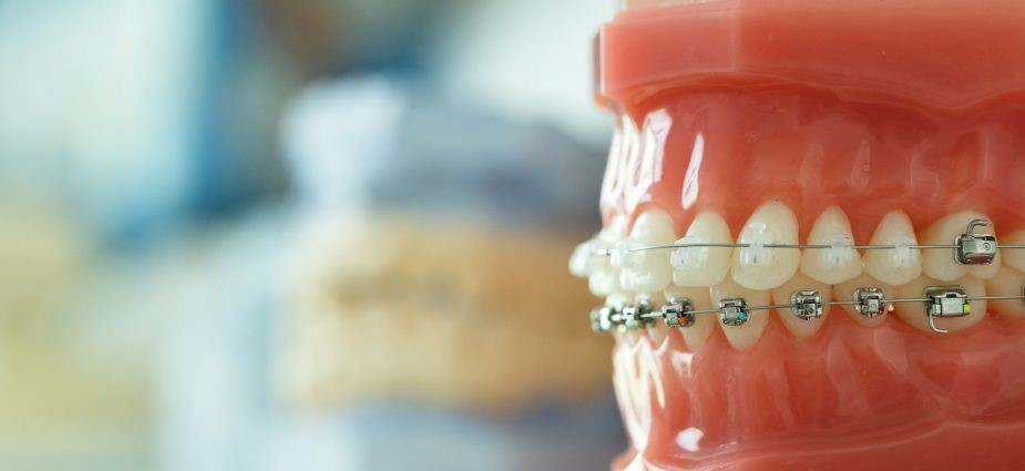 Mistakes People Make When Choosing an Orthodontist