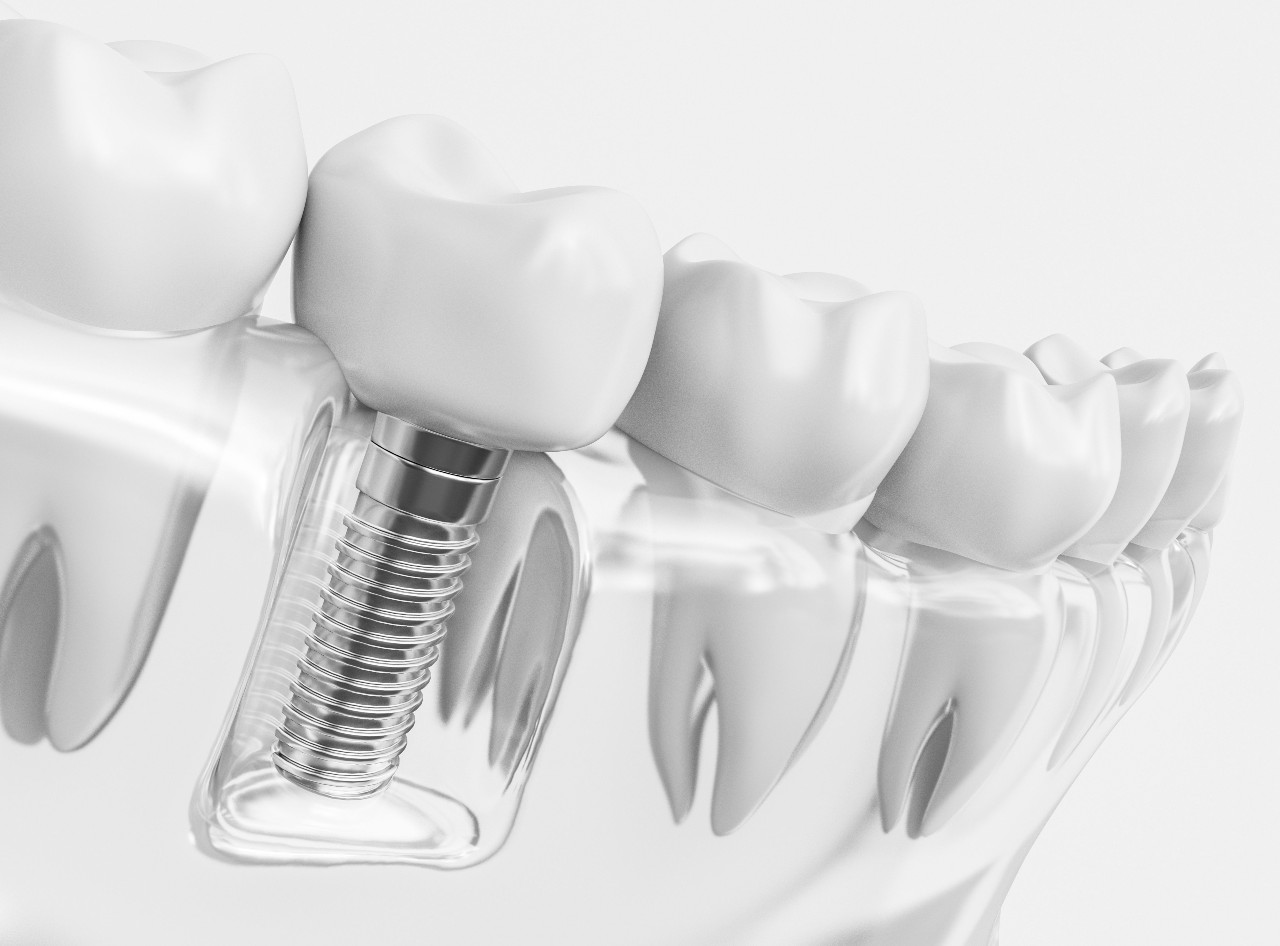 Dental Implant Process